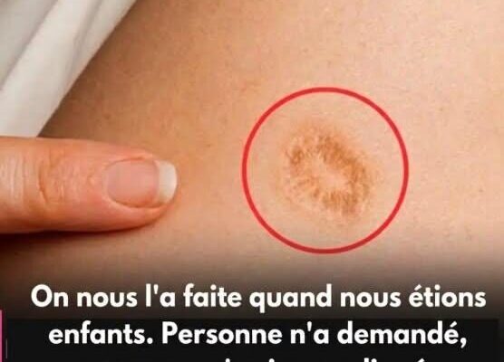 Cette cicatrice ronde sur le bras que beaucoup de gens ont sans vraiment savoir ce qu’elle signifie