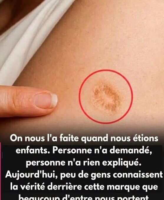 Cette cicatrice ronde sur le bras que beaucoup de gens ont sans vraiment savoir ce qu’elle signifie