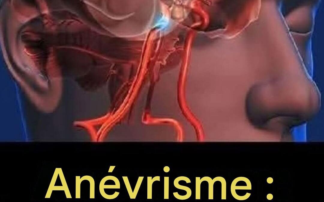 12 signes avant-coureurs d’un anévrisme à ne pas ignorer