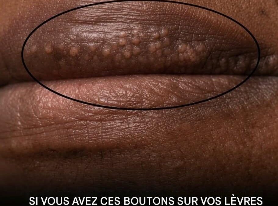 Si vous voyez apparaître des boutons blancs sur vos lèvres ou dans votre zone intime, voici ce que cela pourrait…